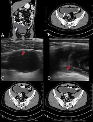 The value of ultrasound combined with CT in identifying early low-grade appendiceal mucinous neoplasm and appendicitis